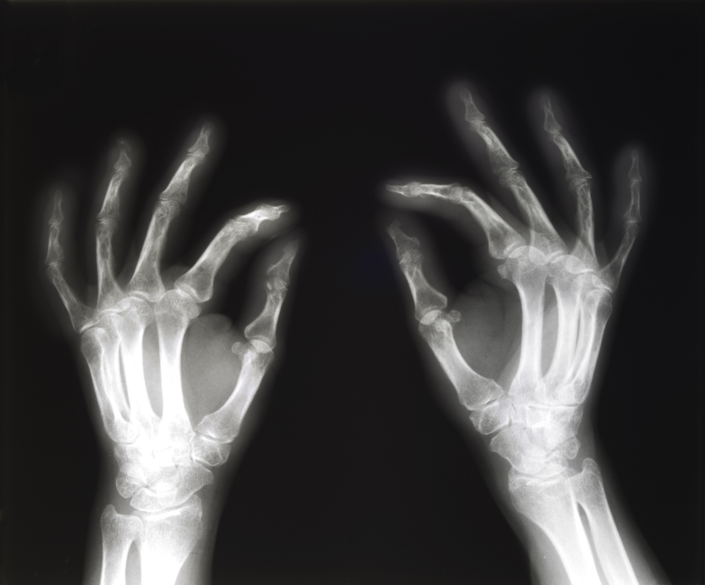 arthrose mains